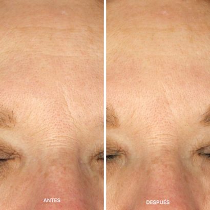 antes-despues-metodo-laCabine-9